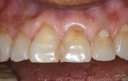 cerec gallery before