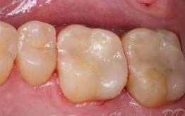 cerec gallery after