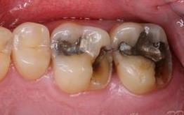 cerec gallery before