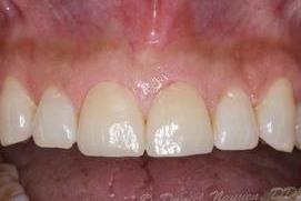 cerec gallery after