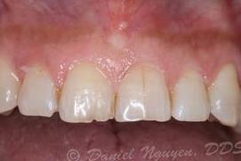 cerec gallery before